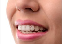 Invisalign Dentist: Get Your Teeth Straightened