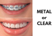Transforming Smiles: The Power of Braces in a clear braces